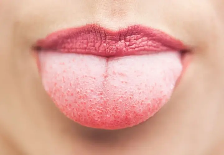 Lingua rosa con puntini rossi, forse un segno di lingua streptococco. Labbra con rossetto scuro.