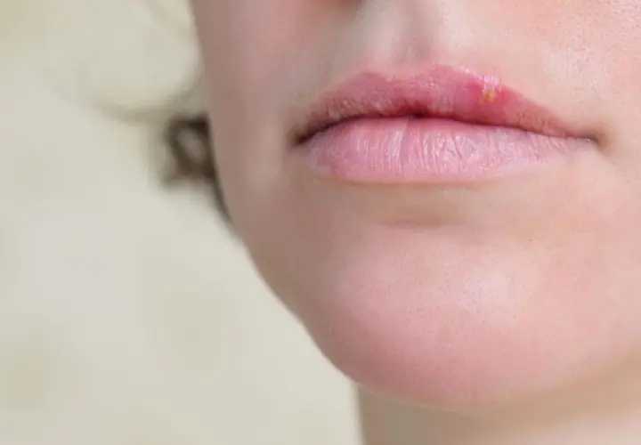 Primo piano delle labbra con una vescicola di herpes che indica perche esce herpes.