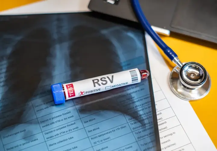 Test na wirus RSV z pozytywnym wynikiem, obok stetoskop i zdjęcie rentgenowskie klatki piersiowej.