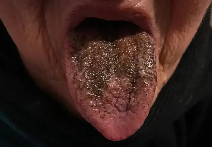 Lingua nera con papille ispessite e macchie scure, come se fosse coperta di terra.