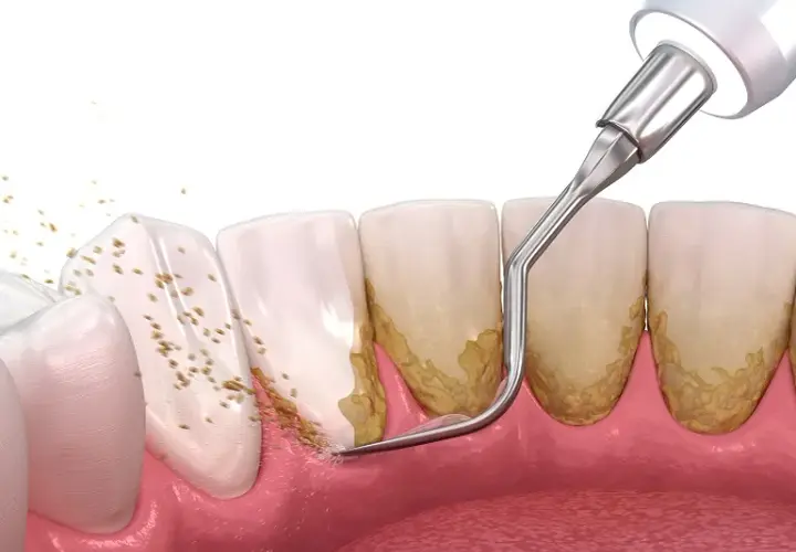 Jak dentysta usuwa kamień nazębny bez bólu i skutecznie?