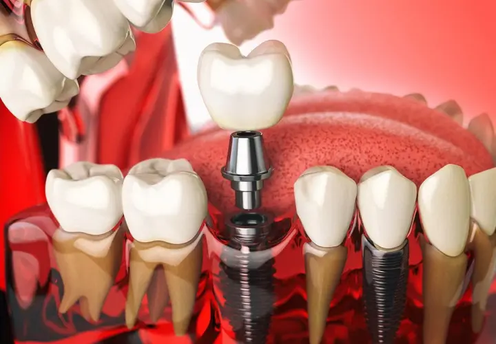 Illustrazione di un impianto perno dente, con la vite inserita nell'osso e la corona in attesa di essere posizionata.