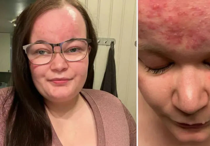 Kvinna med glasögon visar upp sin hud med rodnad och utslag, troligen mild rosacea.