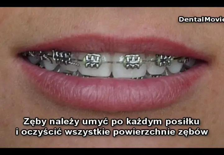 Ile trwa zakładanie aparatu i czy boli? Przewodnik ortodonty