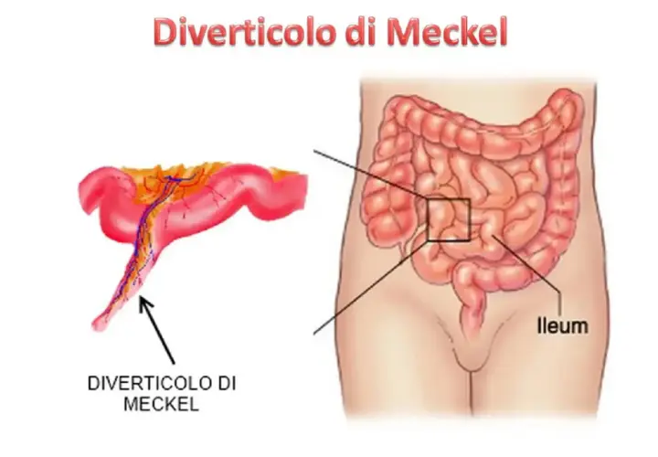 Illustrazione anatomica che mostra un diverticolo di Meckel, una piccola sacca nell'intestino tenue.