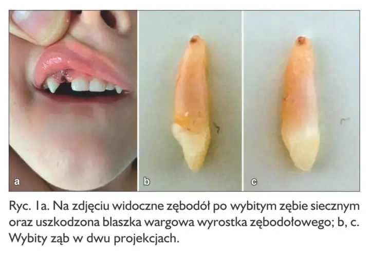 Wypadanie zębów mlecznych u 5 latka: widoczny zębodół po wybitym zębie i uszkodzona warga. Obok wybity ząb w dwóch ujęciach.