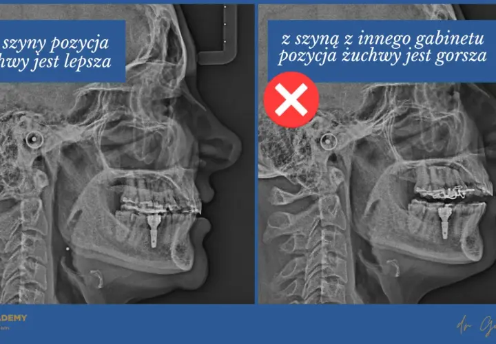 Rentgen żuchwy: po lewej bez szyny Michigan, pozycja lepsza. Po prawej z szyną, pozycja gorsza.