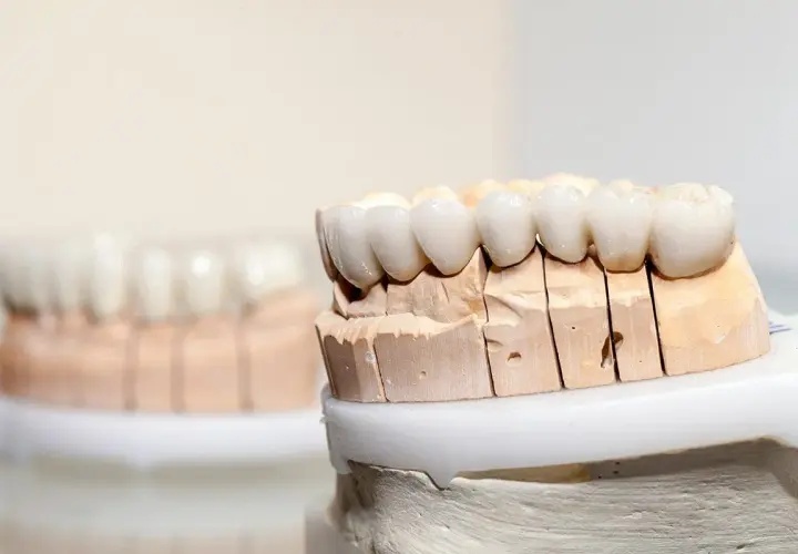 Modelli di denti in porcellana su un supporto in gesso, pronti per essere applicati.