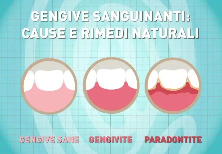Illustrazione mostra gengive sane, gengivite e parodontite, con la progressione che porta a gengive sanguinanti.