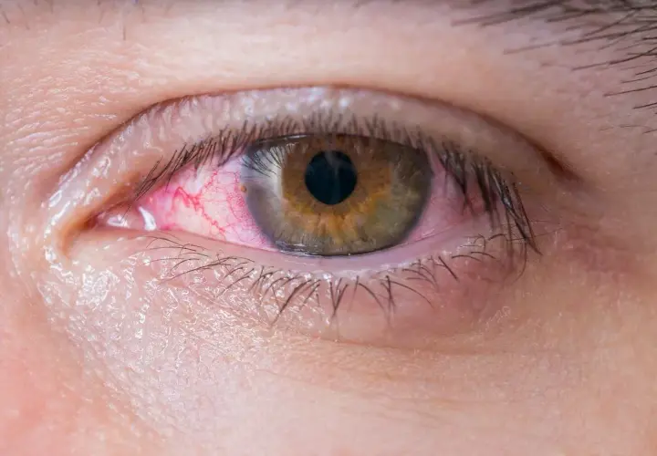 Ojo rojo e irritado, con vasos sanguíneos visibles. Ayuda a entender la diferencia entre conjuntivitis y mocos en los ojos.