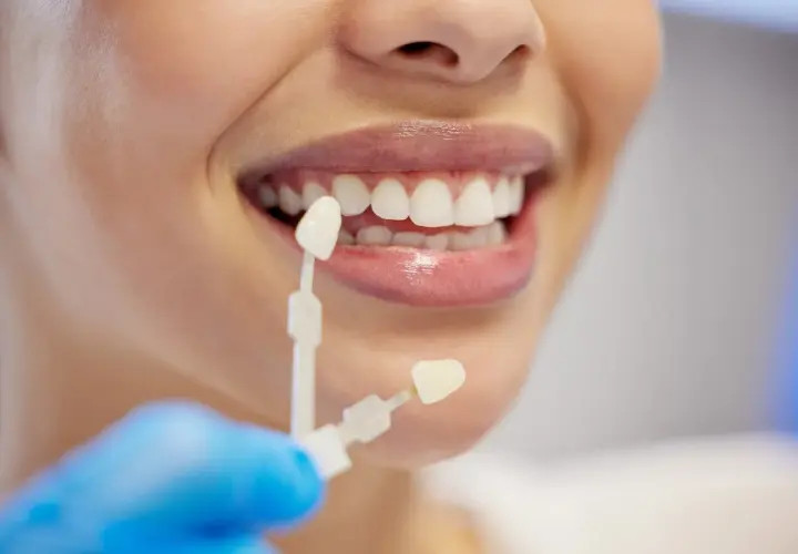 Dobieranie koloru licówek do naturalnych zębów. Na ile zębów zakłada się licówki? Decyzja należy do pacjenta i dentysty.