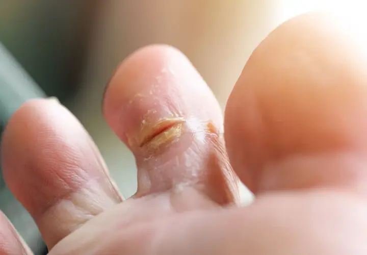 Pieds affectés par une mycose, peut-être contractée à la piscine. La peau entre les orteils est irritée et squameuse.