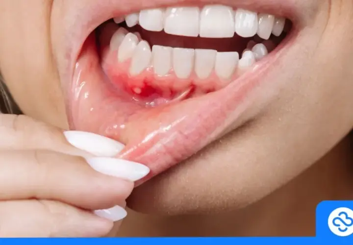 Ropa w dziąśle: Jak sobie pomóc i kiedy pilnie do dentysty?