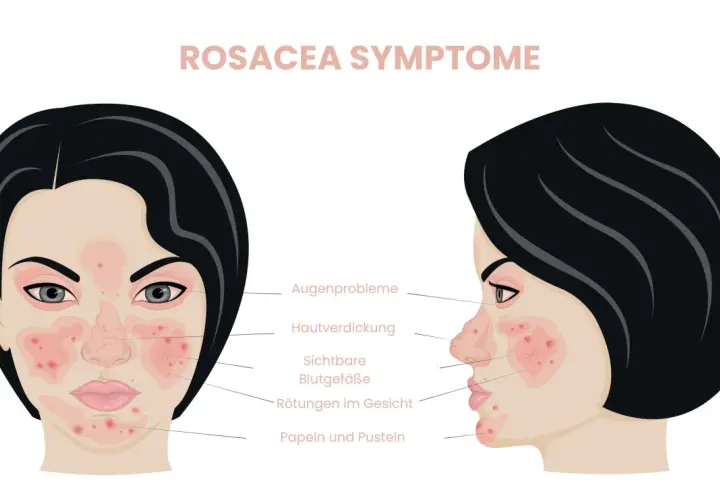 Rosacea-Symptome: Rötungen, sichtbare Gefäße, Papeln. Hausmittel können Linderung bringen.