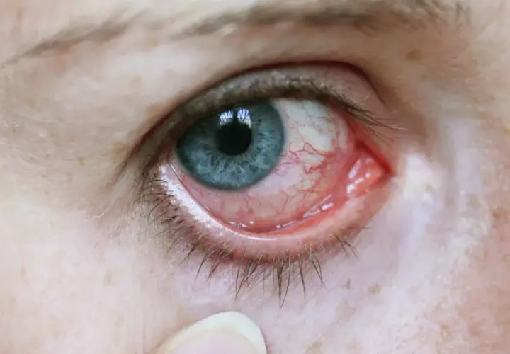 Fibromyalgie Symptome Augen: Unerwartete Beschwerden und Lösungen