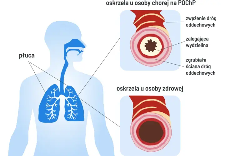Czy POChP kwalifikuje do renty? Sprawdź, co musisz wiedzieć