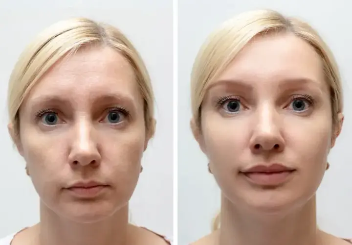 Przed i po zabiegu: wygładzona skóra, zredukowane zmarszczki. Wampirzy lifting efekty widoczne od razu.