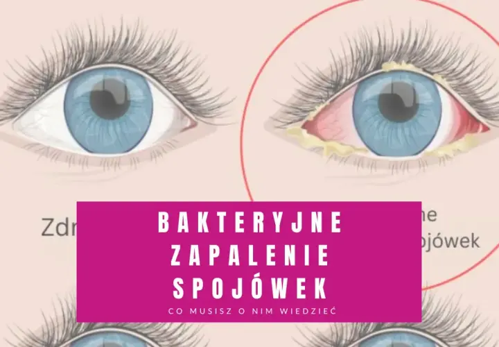 Zdrowe oko obok oka z objawami bakteryjnego zapalenia spojówek: zaczerwienienie, obrzęk i wydzielina.