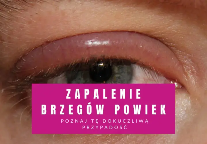 Oko z zaczerwienionym, opuchniętym brzegiem powieki, wskazujące na łojotokowe zapalenie powiek.