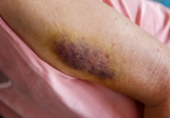 Gros hématome violacé sur un bras, signe d'une jambe en sang suite à un choc. La peau est meurtrie et jaunie par endroits.