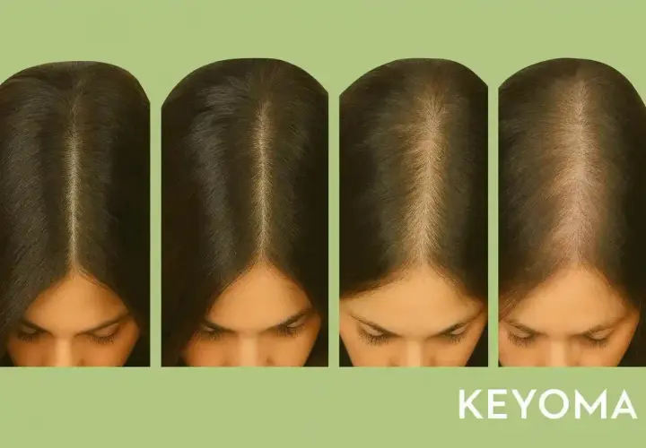 Cuatro imágenes muestran cómo crece el pelo, desde una línea capilar más densa hasta una más fina, ilustrando el proceso.