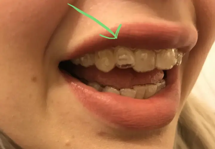 Flecha verde señala un diente donde el **invisalign no encaja**. Se ven los alineadores transparentes en los dientes.