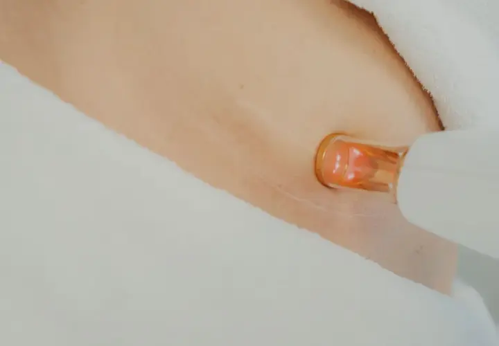 Närbild på hud med laserbehandling för bristningar. En vit apparat med orange spets närmar sig huden.