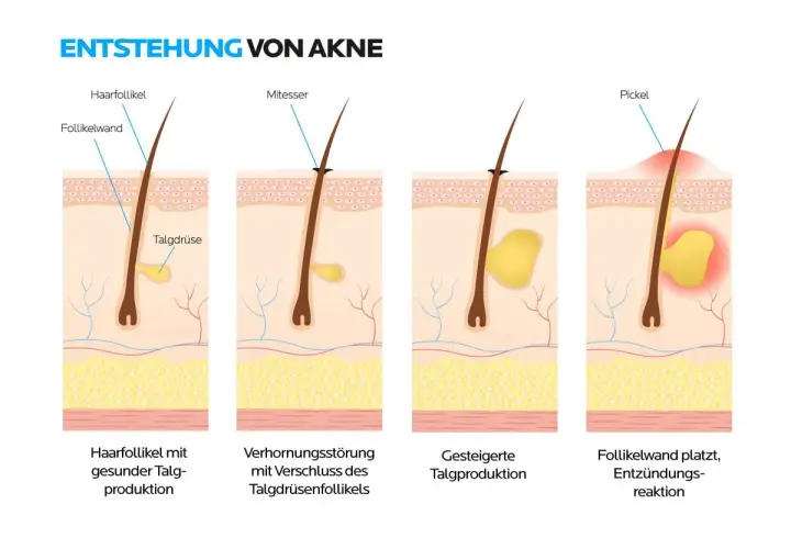 Illustration zeigt, wie entstehen Mitesser: Verhornungsstörung und erhöhte Talgproduktion führen zu verstopften Follikeln, die sich entzünden.