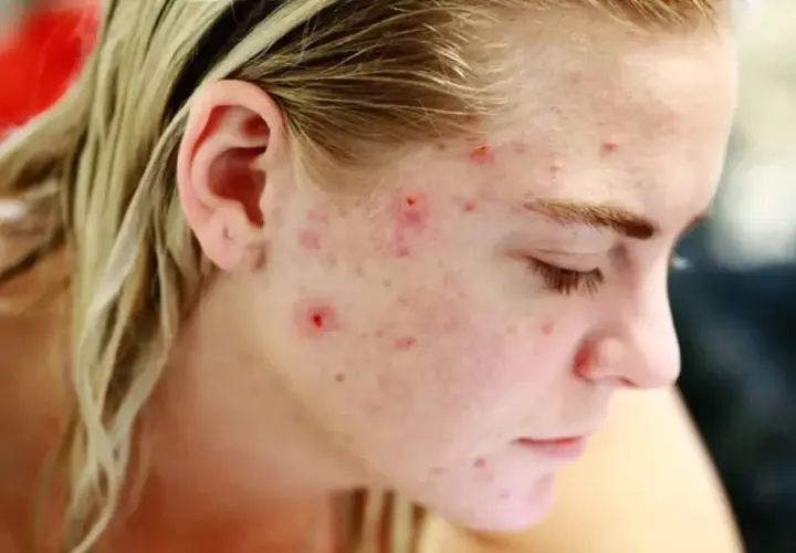 Skóra młodej osoby z widocznymi zmianami trądzikowymi, spowodowanymi przez bakterie Cutibacterium acnes.
