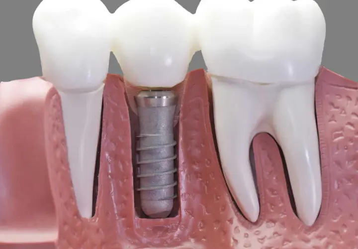 Czy po wszczepieniu implantu zęba można iść do pracy bez obaw?