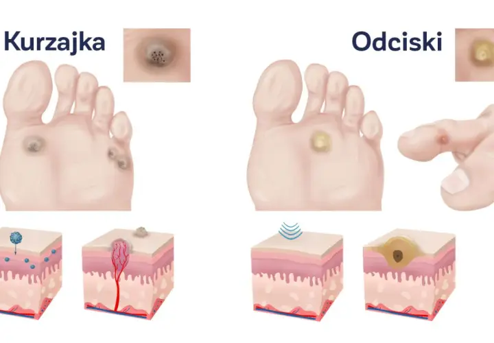 Ilustracja porównuje kurzajki i odciski na stopach. Odcisk na stopie po angielsku to "corn".