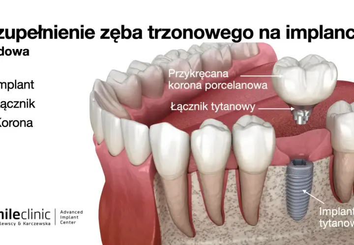 Budowa zęba trzonowego na implancie: implant tytanowy, łącznik i korona porcelanowa.