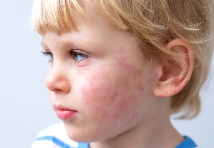 Primo piano del viso di un bambino con macchie rosse sulle guance, possibili macchie allergie alimentari bambini.