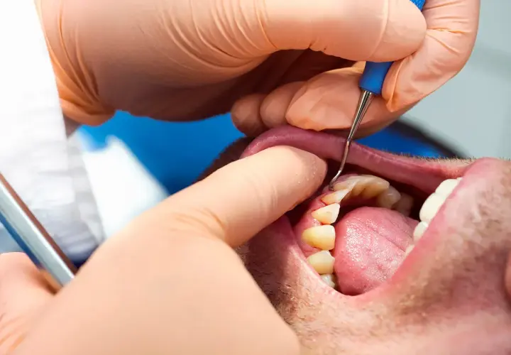 Dentista esamina i denti per valutare la parodontite, cercando i migliori rimedi per la salute gengivale.