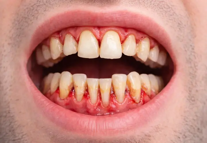 Encías inflamadas y enrojecidas alrededor de los dientes, indicativo de periodontitis leve.
