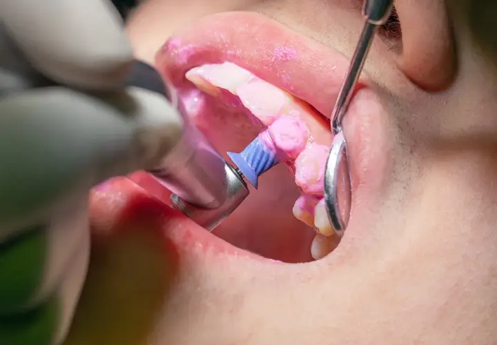 Dettaglio di un trattamento di igiene orale: il dentista usa uno strumento rotante per pulire i denti, coperti da una pasta rosa.