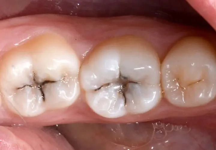 Denti con piccole carie scure nelle fessure.