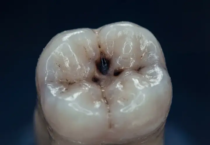 Dente con una cavità scura al centro, un chiaro segno di carie. I sintomi iniziali possono essere sottili, ma questa immagine mostra la progressione.