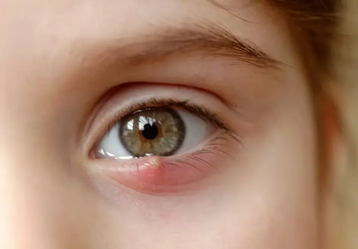 Un œil enfantin avec un orgelet rouge et gonflé sur la paupière inférieure. Le pu dans les yeux est visible.