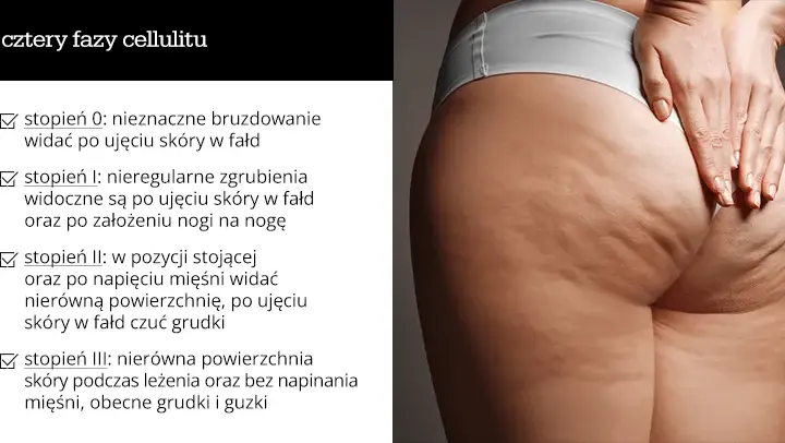 Cellulit: Jak szybko wygładzić skórę? Poznaj kompleksowy plan.