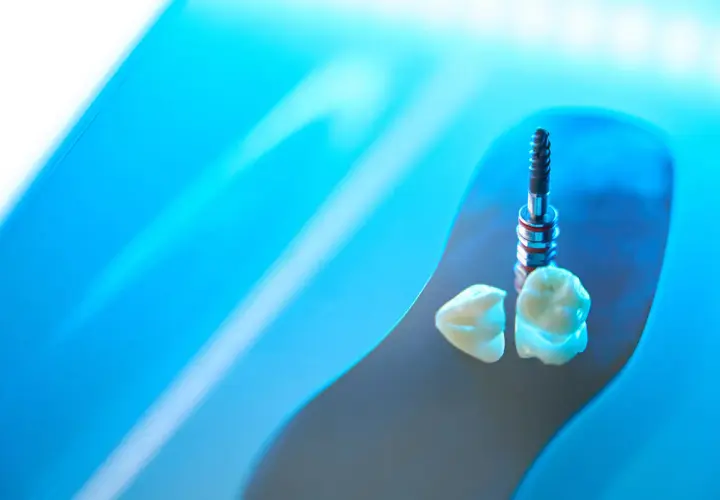 Impianti in zirconia e corone dentali, un futuro di sorrisi perfetti.