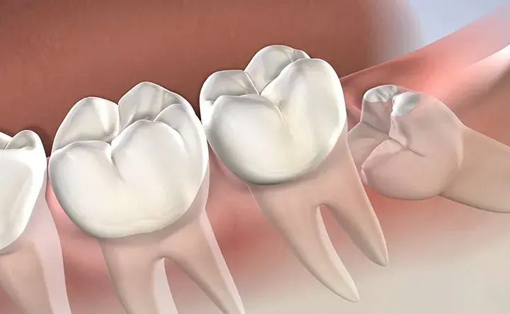 Medicamentos que se recetan después de una extracción dental y sus efectos
