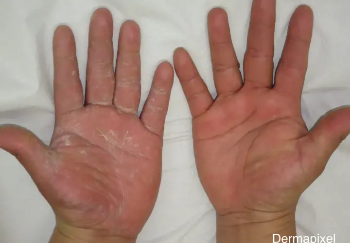 Manos con piel seca y escamosa en la izquierda, que podría indicar que significa cuando te pica la mano derecha. La mano derecha se ve sana.