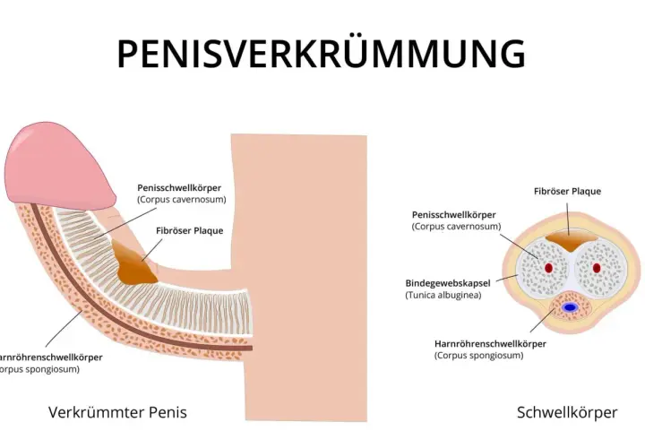Illustration zeigt einen verkrümmten Penis mit fibrosen Plaques, die den Penisschwellkörper beeinträchtigen. Ein "buried penis" ist hier nicht dargestellt.
