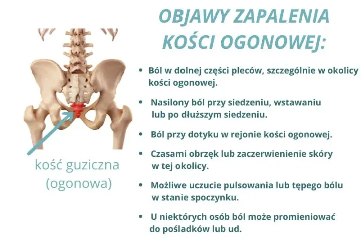 Ból kości ogonowej: Przyczyny, objawy i skuteczne leczenie