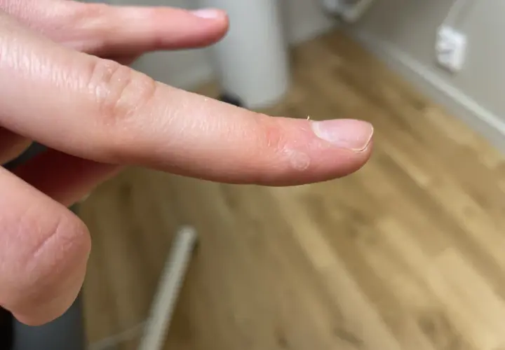 Närbild på en finger med en liten vårta på handflatan. Vårtan har en ringformad struktur.
