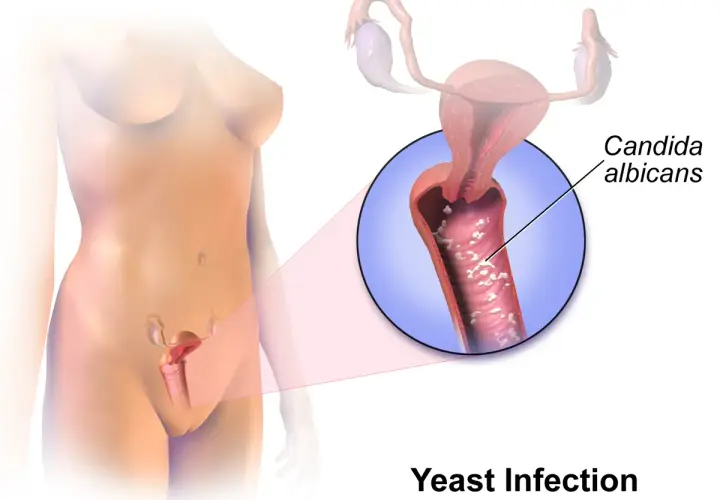 Illustration visar svamp i underlivet, orsakad av Candida albicans. Förstorad bild visar infektionen i slidan.