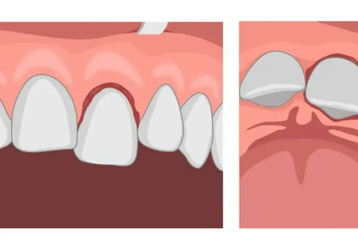 Illustrazione di gengive infiammate e denti che si allentano, suggerendo la possibilità di denti che cadono senza dolore.