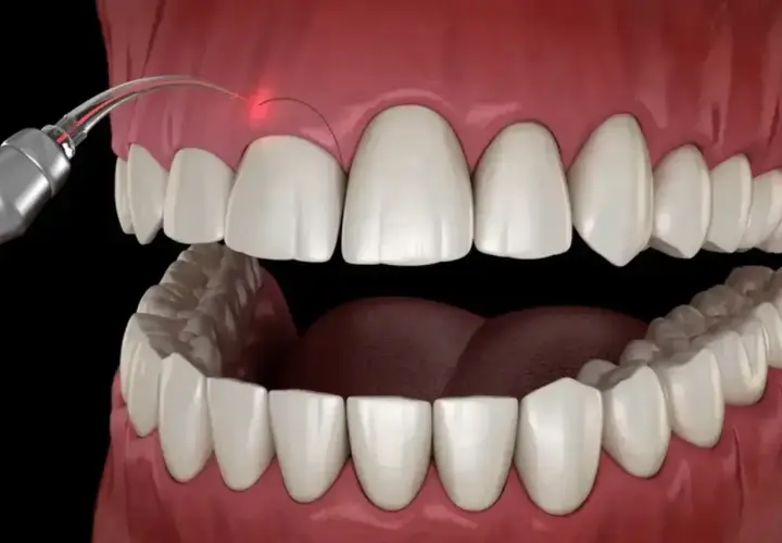 Zabieg gingiwektomii laserem. Czerwony promień lasera precyzyjnie modeluje dziąsło wokół białych zębów.