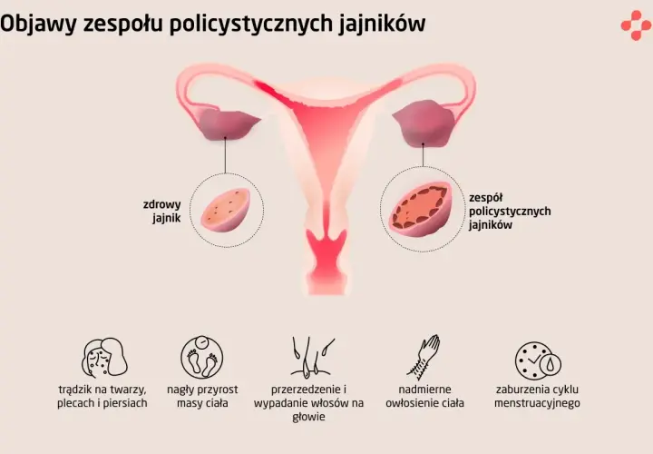 Ilustracja porównuje zdrowy jajnik z jajnikiem w zespole policystycznych jajników, pokazując objawy takie jak trądzik, przyrost masy ciała i zaburzenia cyklu.